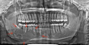 Case 2- pre surgery xray