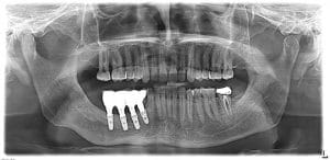 picture 10- xray after teeth replacement