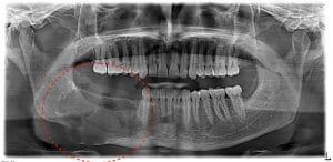 Case 2- x ray immedaitely after surgery