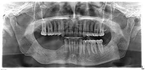case 2- healing after 1 year