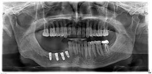 picture 5- dental implant placement