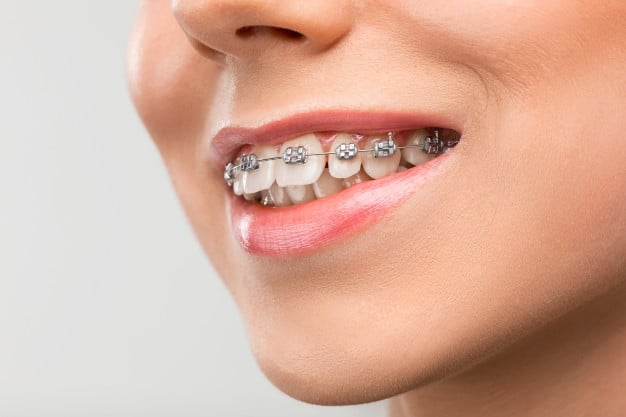 Read more about the article All You Need To Know About Braces