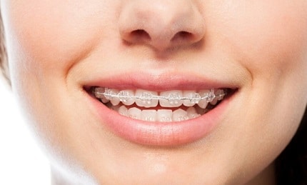 Ceramic Braces