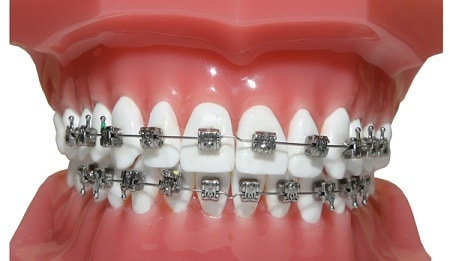 Conventional Braces