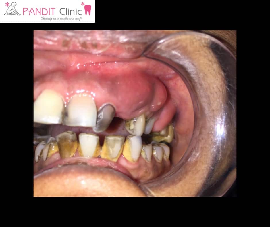 Gum abscess or boils