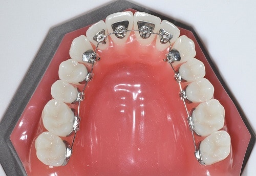 Lingual Braces