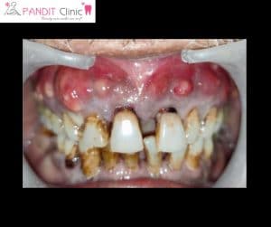 Swelling gums