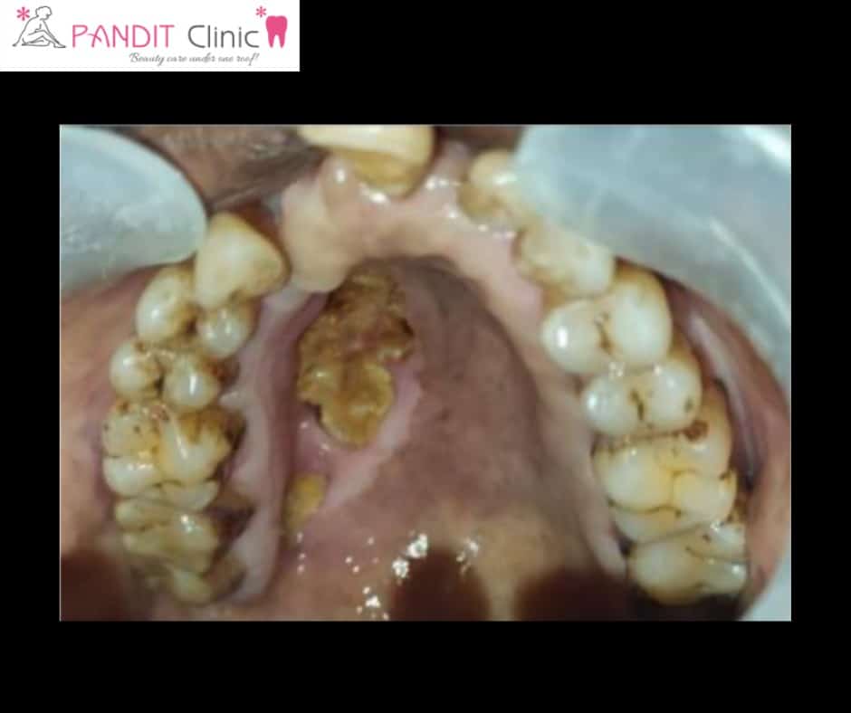 mobility of teeth