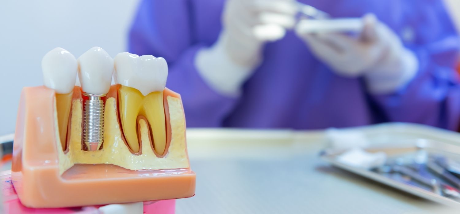 You are currently viewing Teeth Replacement After Mucormycosis At Pandit Clinic