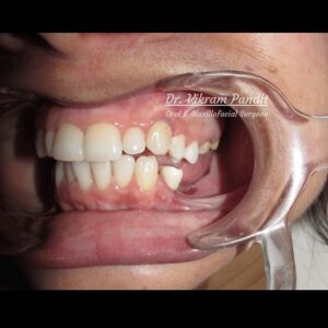 Missing teeth in lower jaw preop