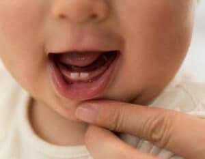 Natal and neonatal teeth