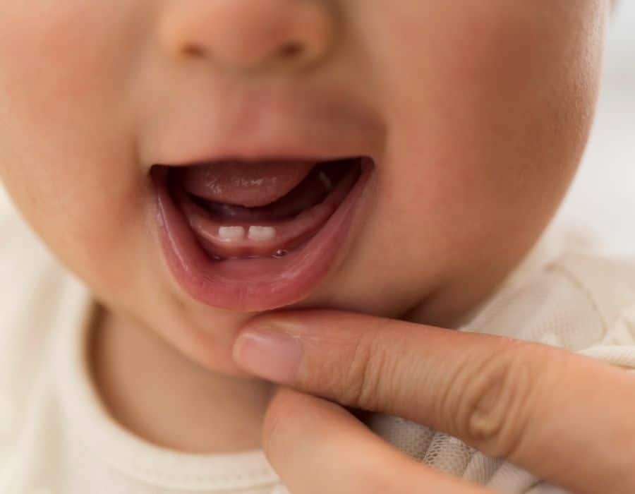 What To Do If Your Baby Has Natal Or Neonatal Teeth