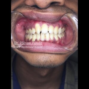 Corrective jaw Surgery case 2