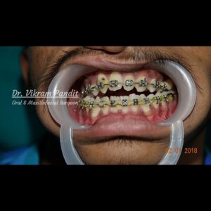 Corrective Jaw Surgery Case 2