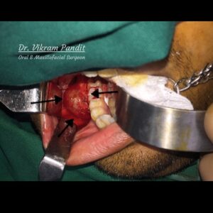 jaw cyst operation image