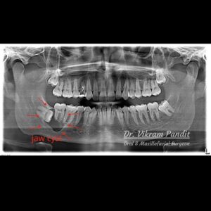 jaw cyst preop radiograph