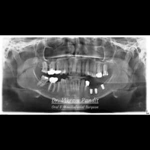 Radiograph showing placement of dental implants