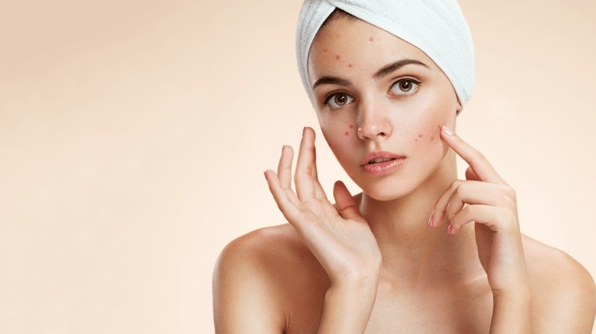 Read more about the article Acne Treatment