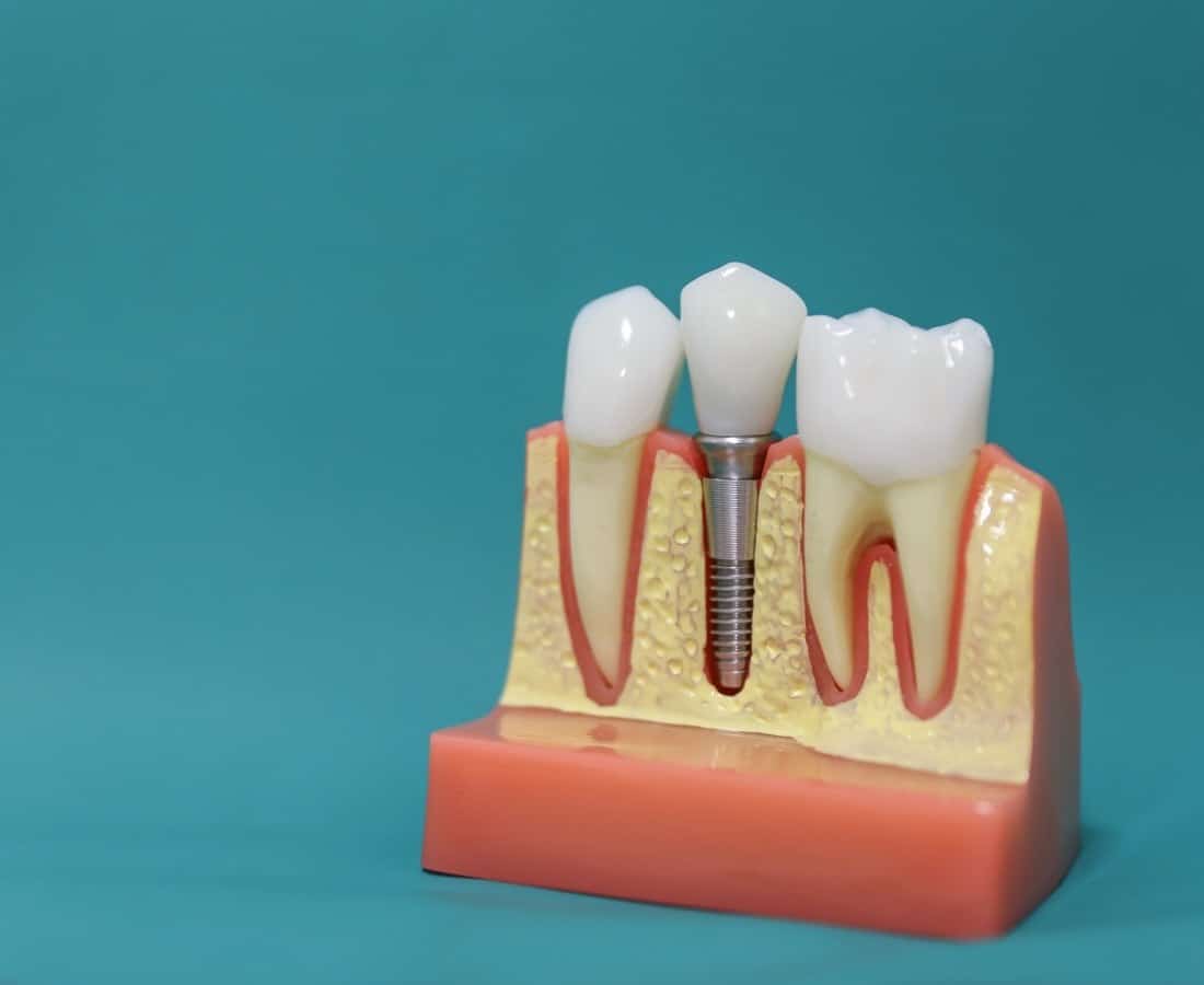 Dental Implants To Replace Missing Teeth