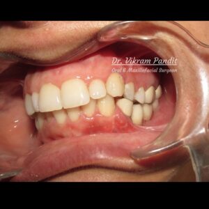 Fixed teeth using dental implants