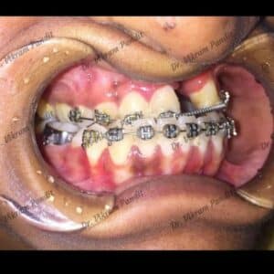 cleft orthognathic - orthodontics 2