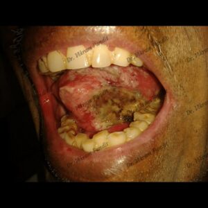 jaw-tumour-tobacco