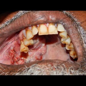 tobacco-mouth-cancer-case-1