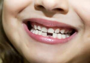The Importance of Space Maintainers for Children's Teeth