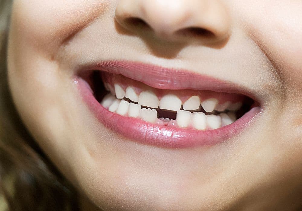 Read more about the article The Importance of Space Maintainers For Children’s Teeth