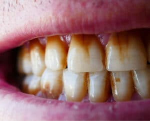 Hypermineralised Teeth