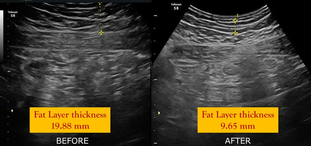 HIFEM-treatment-before-after-1