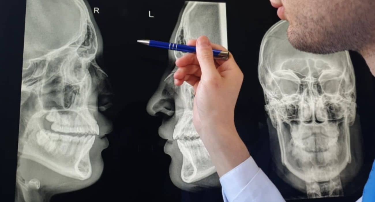 Read more about the article Facial Fractures: Causes And Treatment