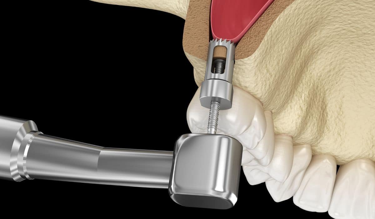 Read more about the article Sinus Lift Procedure for Dental Implants at Pandit Clinic – Dr. Vikram Pandit