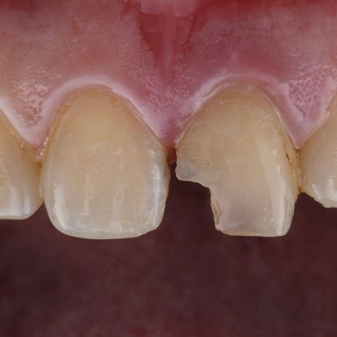 Dental Trauma in Children: First Aid, Prevention & Treatments