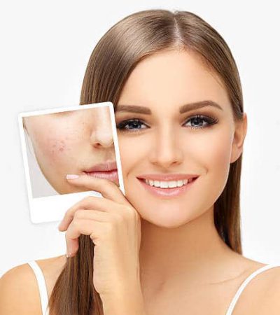 Portrait of girl with problem and clear skin Acne Scar Surgery
