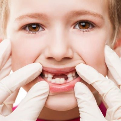 Tooth Decay Tooth Decay in kids