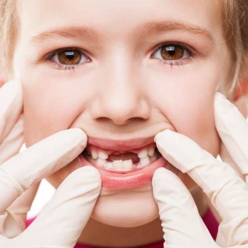 Tooth Decay in kids