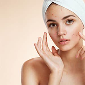 acne_girl acne_pimples