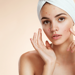 acne treatment acne treatment