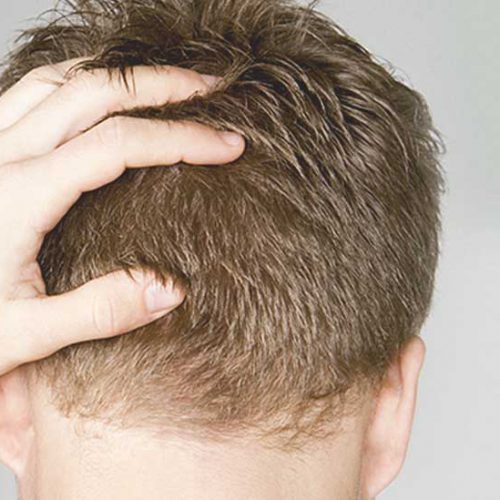 hair-transplant