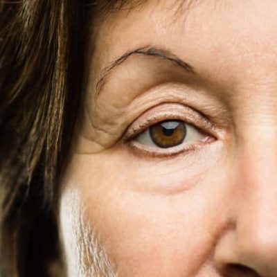 Ptosis Ptosis