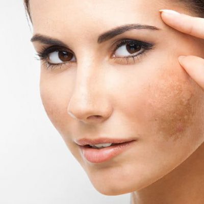skin pigmentation skin pigmentation