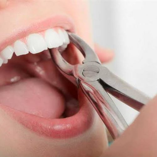 tooth extraction tooth-extraction