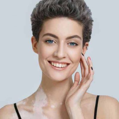 vitiligo vitiligo