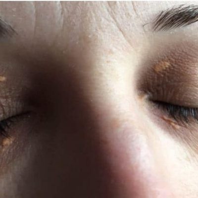 xanthelasma xanthelasma